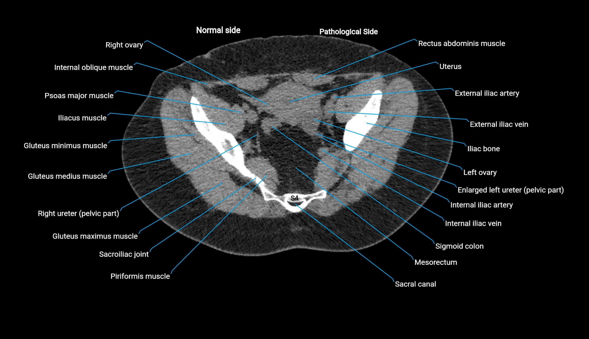 CT KUB axial cross sectional anatomy  radiology image -img-00201-00136.webp